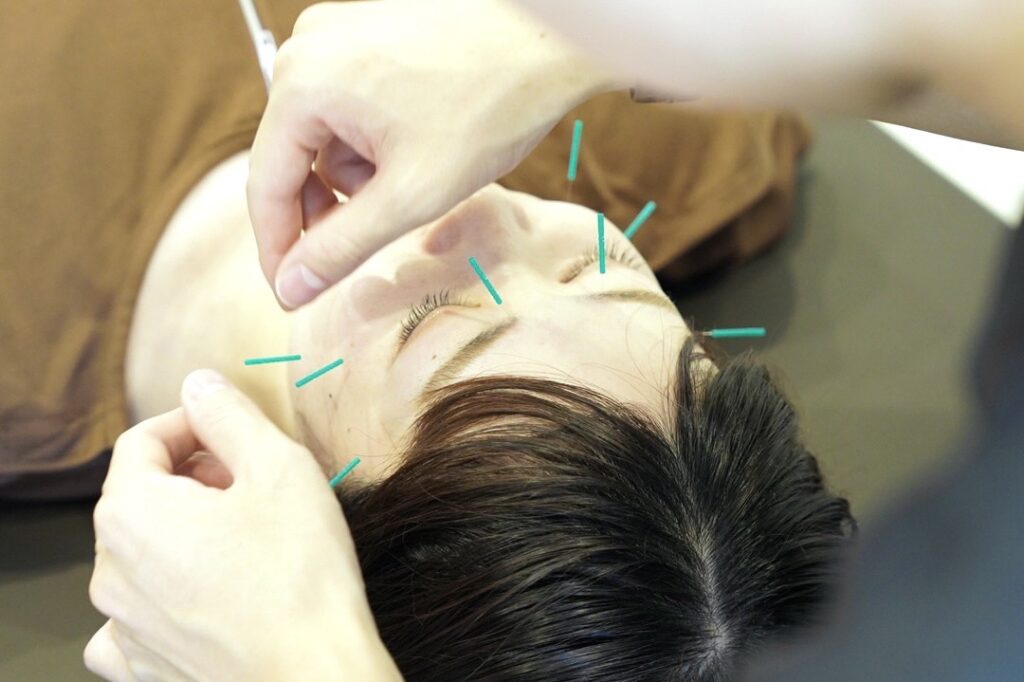 美容鍼灸の施術で患者様のお顔に鍼をさしている写真
